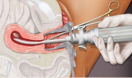 4-5-6-7-8-9 Haftalık Kürtaj