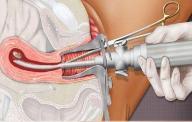 4-5-6-7-8-9 Haftalık Kürtaj
